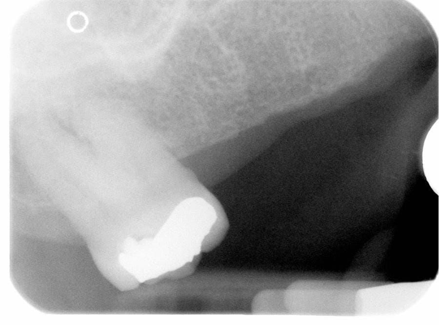 Figure 13. Pre-treatment radiograph - UR7 - occlusal amalgam. 10- 20% alveolar bone loss. Healthy periodontium with reduced attachment level. No mobility.