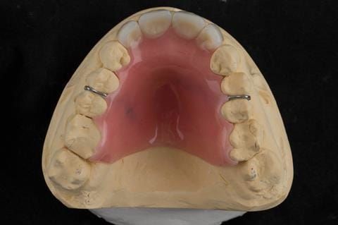 Figure 24. Maxillary cast with immediate partial denture processed and fitted as per design in figure 13. Schottlander Enigmalife teeth.