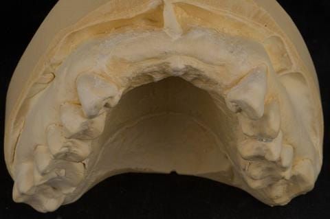 Figure 58. Reline cast.