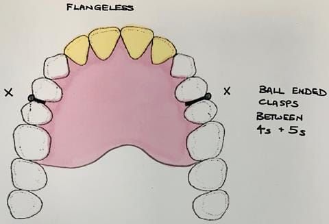 Figure 14. Immediate maxillary denture flangeless design, to be fitted at the extraction appointment of UR21, UL12. Colletted with two ball ended clasps. Denture to be worn over 9 - 12 months duration to allow for ridge resorption.