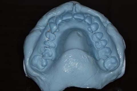 Figure 80. Impression made of immediate denture in situ for Rowan (Dental Technician) to use for copying tooth positions in the definitive denture.