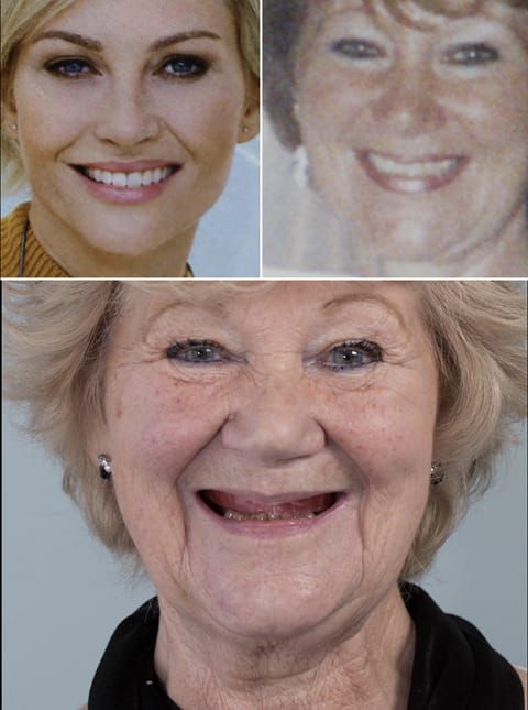 Figure 40. Visit 3 - maxillary wax rim carved with reference to photos supplied by the patient. These images are sent to Rowan (dental technician) to set up the artificial teeth.