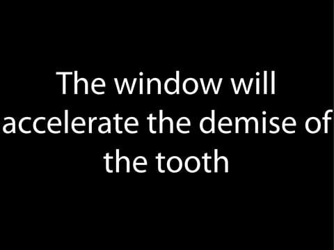Figure 86. I warn the patient prior to commencing treatment that the denture will accelerate the demise of the remaining support tooth.