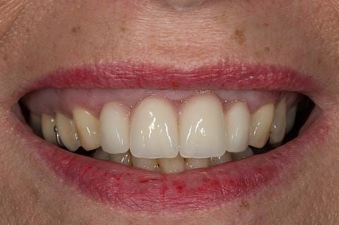 Figure 34. Maxillary immediate denture fitted one week after the extraction appointment. Schottlander Enigmalife teeth.