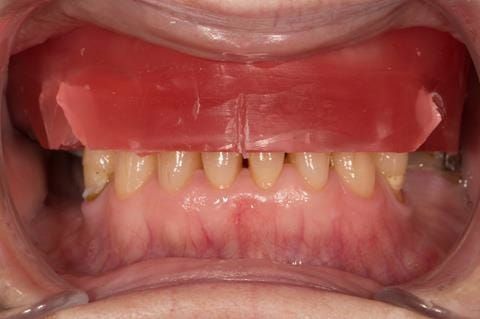 Figure 32. Visit 2 - Primary rim carved approximately to the desired occlusal vertical dimension, allowing the definitive casts to be mounted on the articulator, for construction of the central bearing apparatus (gothic arch tracing).
