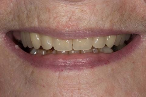 Figure 80. Visit 5 Fitted definitive denture - Schottlander Enigmalife teeth