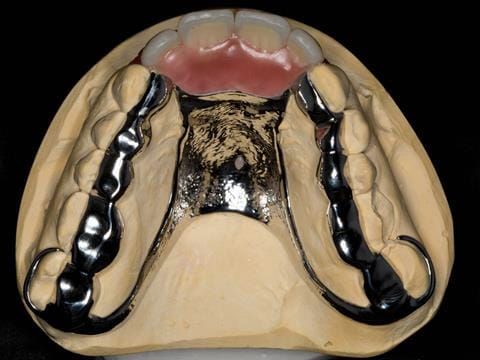 Figure 101. Maxillary cobalt chromium framework trial insertion with teeth fitted into wax. This was taken to the mouth and assessed by the patient to verify the aesthetics and approve finishing the partial denture.