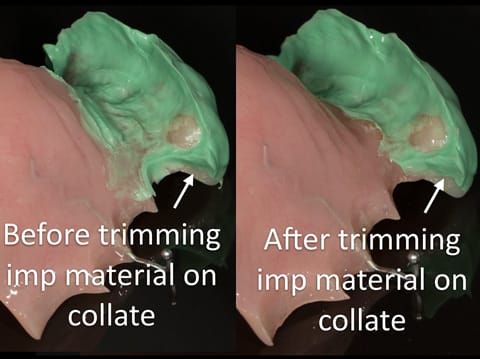 Figure 54. Immediate denture laboratory reline - part 1 with light bodied silicone impression material (Doric Flo light - Schottlander). Collet trimmed to allow flow of alginate in the over impression - part 2.