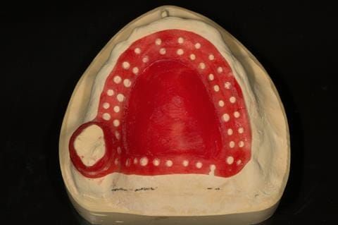 Figure 21. Visit 2. Mock up of cobalt chromium base in pattern resin to try in so that patient can assess where there will be visible metal in final denture.