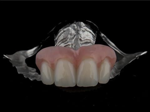 Figure 107. Finished cobalt chromium based maxillary partial denture with Schottlander Enigmalife teeth.