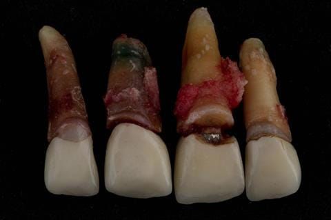 Figure 29. Extracted upper four incisors