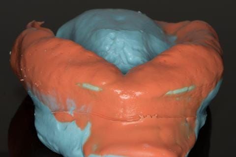 Figure 17. Visit 1. Maxillary primary impression made in two stages using Accudent XD, Ivoclar. This allows full extension to record the sulcus - particularly around the UL7