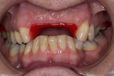 Figure 89. Pattern resin framework prototype of the cobalt chromium connectors to verify fit and occlusal relation - in situ.