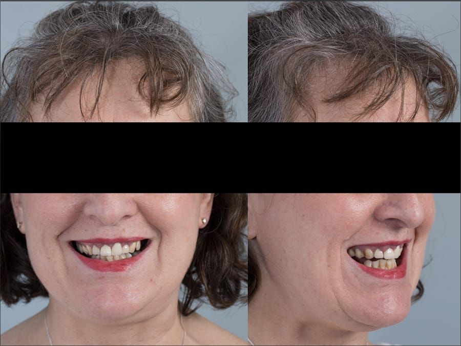 Figure 1 a & b. Pre-treatment showing high smile line and aesthetically poor upper incisors
