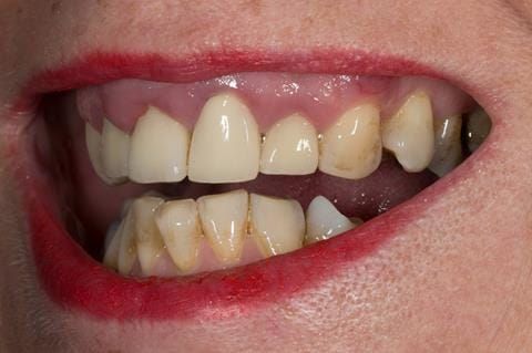 Figure 4. Pre-treatment showing high smile line and aesthetically poor upper incisors