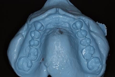 Figure 82. Maxillary special tray definitive impression made in alginate recording depth of the anterior sulcus above the upper 2-2.