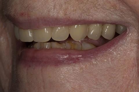 Figure 82.Visit 5 Fitted definitive denture - Schottlander Enigmalife teeth