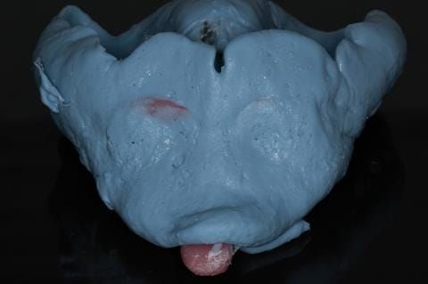 Figure 83. Maxillary special tray definitive impression made in alginate recording depth of the anterior sulcus above the upper 2-2.