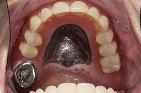 Figure 59. Visit 4 Teeth wax try in with Schottlander Enigmalife teeth in mouth.