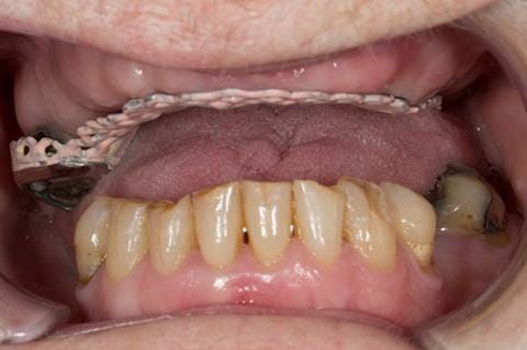 Figure 49. Visit 3 - Cobalt chromium base reinforcement for the maxillary partial denture - Chris Hesketh, Bespoke Frameworks, Chorley, UK..