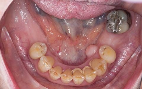 Figure 12. Pre-treatment - occlusal view - lower arch. Worn incisal edges. Oral hygiene inadequate. Calculus on lingual surface of lower anterior teeth. Mandibular torus - can indicate bruxism. Reference given.
