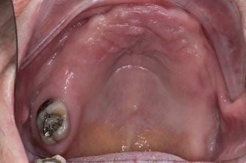 Figure 11. Pre-treatment - occlusal view - upper arch. Midline maxillary torus. - UR7 - occlusal amalgam. Healthy periodontium with reduced attachment level. No mobility.