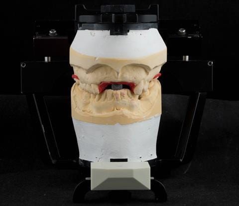 Figure 86. Pattern resin framework prototype of the cobalt chromium connectors to verify fit and occlusal relation - on Denar Mk 2 articulator.