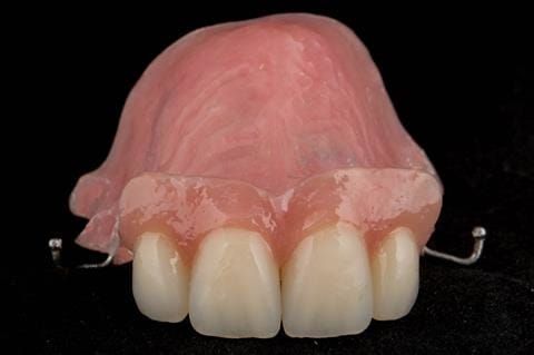 Figure 63. Relined immediate denture with added flange.