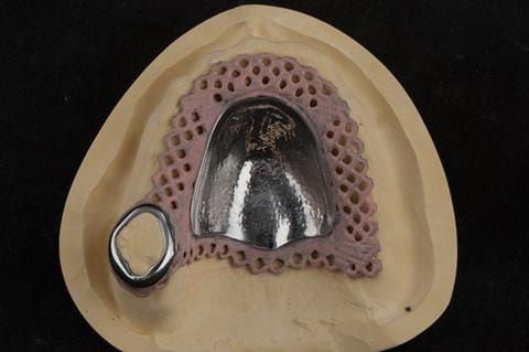 Figure 35. Technical work for visit 3. Cobalt chromium base reinforcement for the maxillary partial denture - Chris Hesketh, Bespoke Frameworks, Chorley, UK.