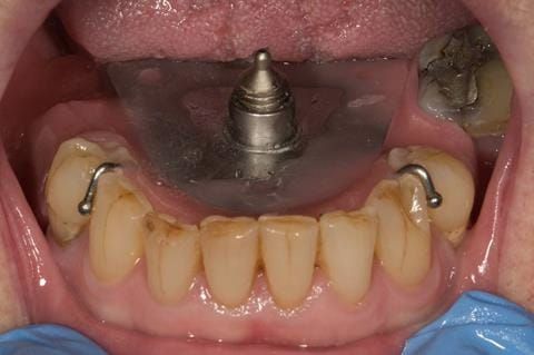Figure 41. Visit 3 - mandibular plate/pin for the central bearing apparatus to record centric relation