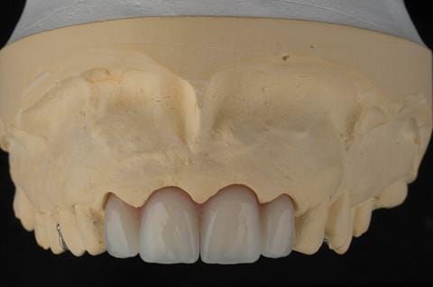 Figure 22. Maxillary cast with immediate partial denture processed and fitted. Schottlander Enigmalife teeth.
