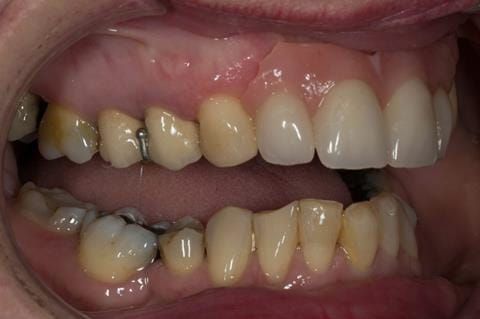 Figure 72. Immediate denture at 11 months post extraction. Ready to start making definitive cobalt chromium based partial denture.