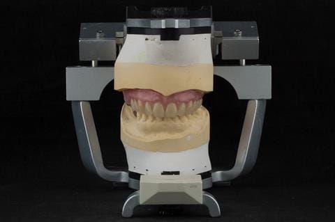 Figure 71. Definitive denture finished with Molloplast B "O" ring around UR7.