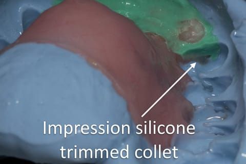 Figure 57. Immediate denture laboratory reline - part 2 alginate over impression in stock tray. Blueprint Dentsply.