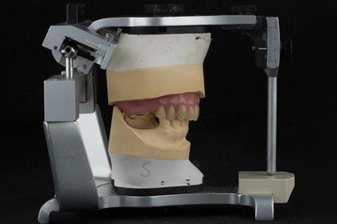 Figure 69. Definitive denture finished with Molloplast B "O" ring around UR7.