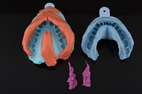 Figure 17. Maxillary primary impression made in two stages using Accudent XD, Ivoclar. The mandibular impression made using Blueprint, Dentsply. Inter-maxillary record made in Futar D, Kettenbach.