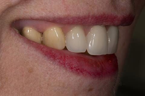 Figure 67. Relined immediate denture replacing maxillary incisors fitted 5 months after extraction.