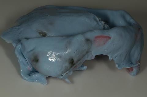 Figure 31. Maxillary special tray definitive impression made in alginate (Dentsply Blueprint) recording depth and width of sulcus.
