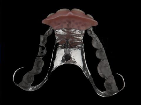 Figure 108. Finished cobalt chromium based maxillary partial denture - fitting surface. Cobalt chromium framework electrolytically polished where it contacts palatal soft tissue for hygiene and unpolished where it touches the teeth to maximise retention.