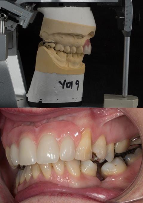 Figure 115. Fitted cobalt chromium based maxillary partial denture replacing upper 2-2 in intercuspal position. Schottlander Enigmalife teeth.