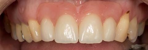 Figure 65. Relined immediate denture replacing maxillary incisors fitted 5 months after extraction. Apologises for lipstick on teeth and staining on UL3.