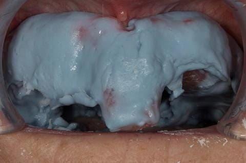 Figure 28. Maxillary special tray definitive impression made in alginate (Dentsply Blueprint) recording depth and width of sulcus.