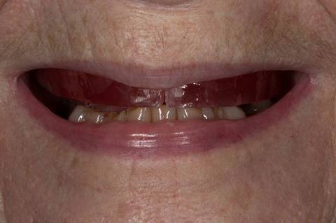 Figure 38. Visit 3 - maxillary wax rim carved with reference to photos - figures 14 and 15.
