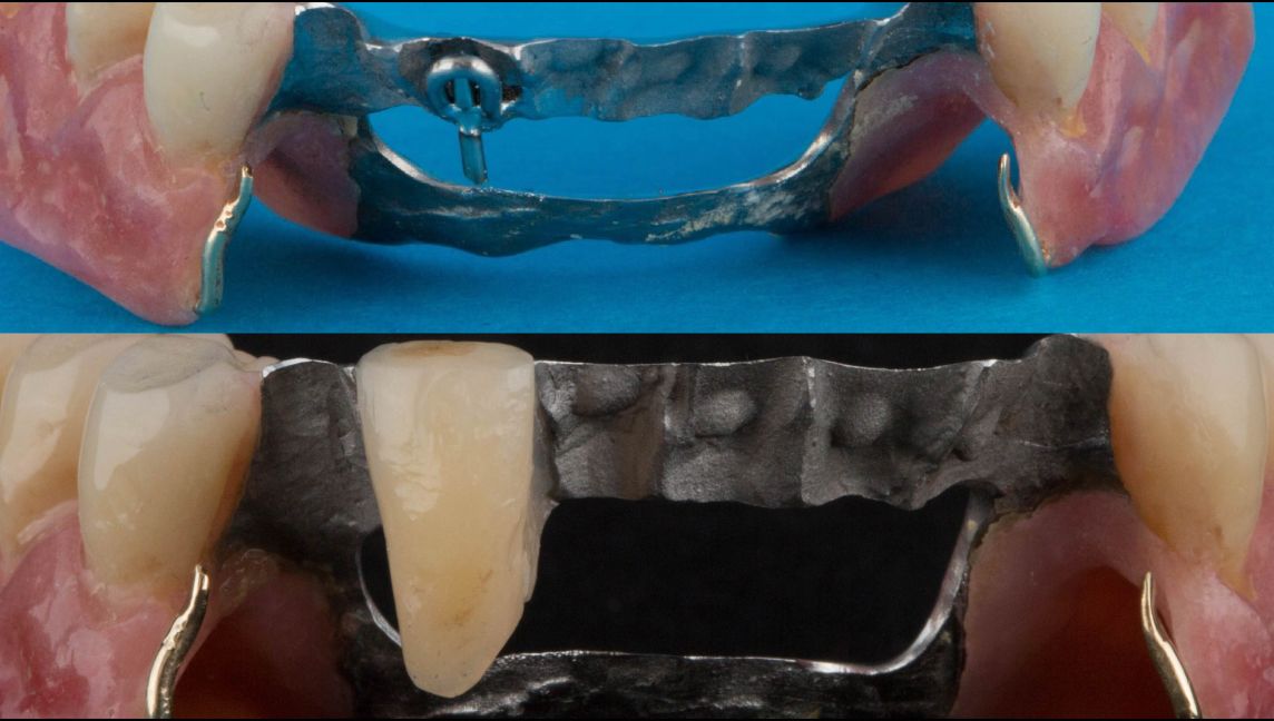 Addition of a prosthetic tooth onto the dental bar in the event of a natural support tooth failing.