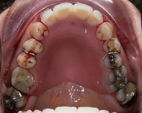 Figure 32. Maxillary immediate denture fitted at the extraction appointment - showing no gaps between the denture and teeth.