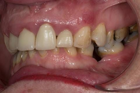 Figure 9. Pre-treatment - upper four incisors with inflammation of the gingivae and mis-match of the gingival levels.