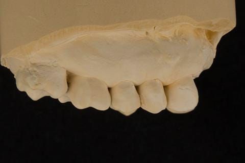 Figure 60. Reline cast.
