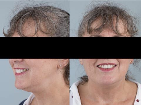 Figure 33. Maxillary immediate denture fitted one week after the extraction appointment. Schottlander Enigmalife teeth.