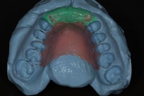 Figure 56. Immediate denture laboratory reline - part 2 alginate over impression in stock tray. Blueprint Dentsply.