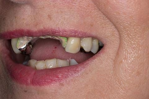 Figure 97. Maxillary cobalt chromium framework trial insertion, checking the fit onto the natural teeth using Occlude spray.
